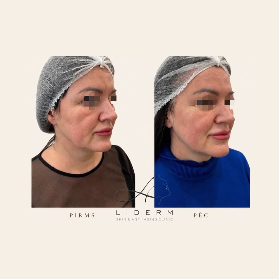 Результат — до и после в клинике LIDERM