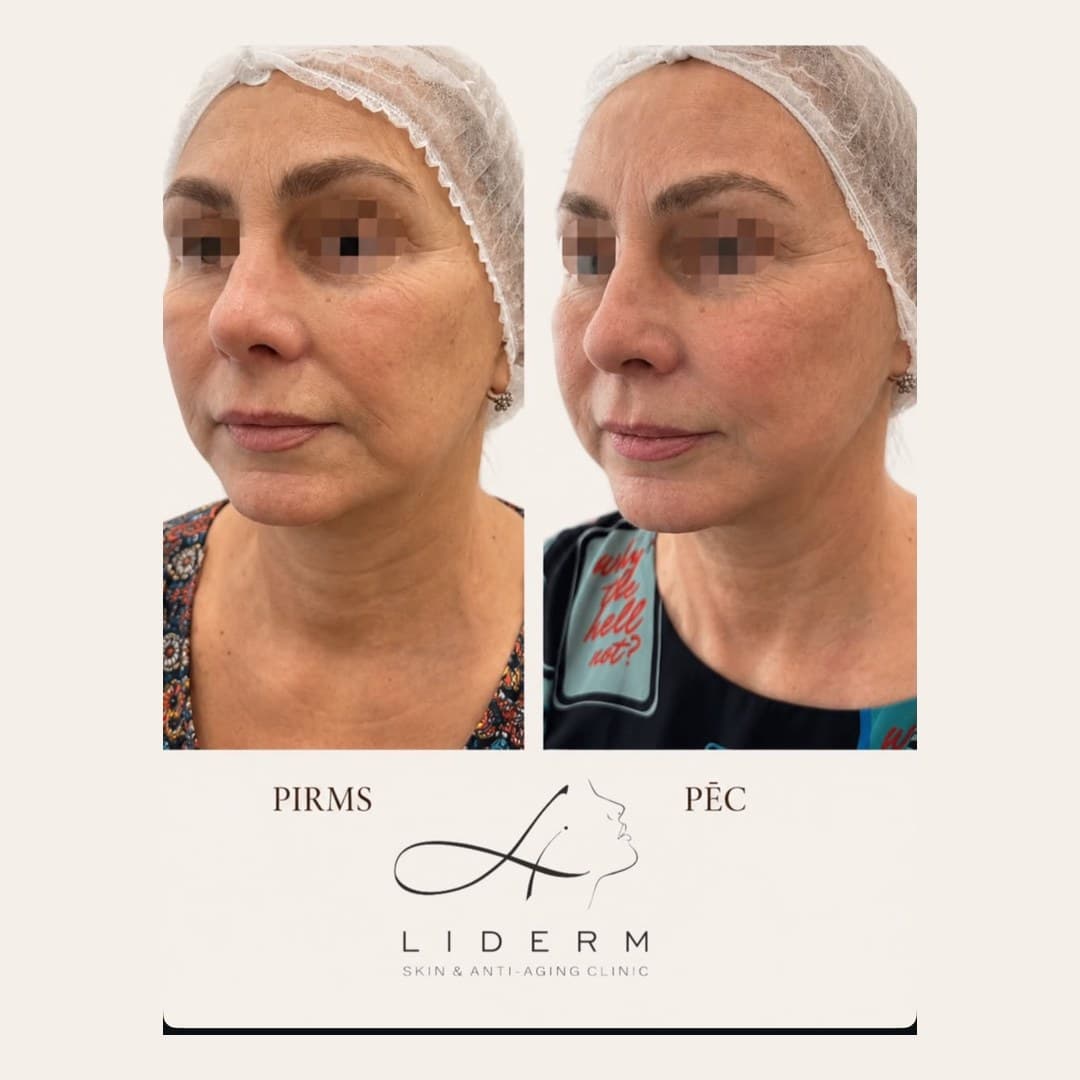 Результат — до и после в клинике LIDERM