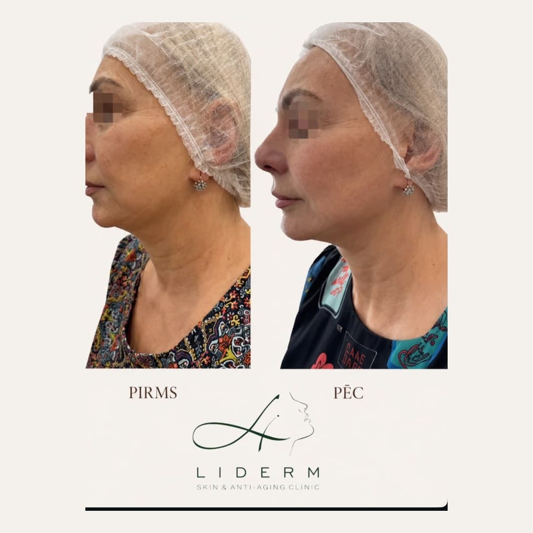 Результат — до и после в клинике LIDERM