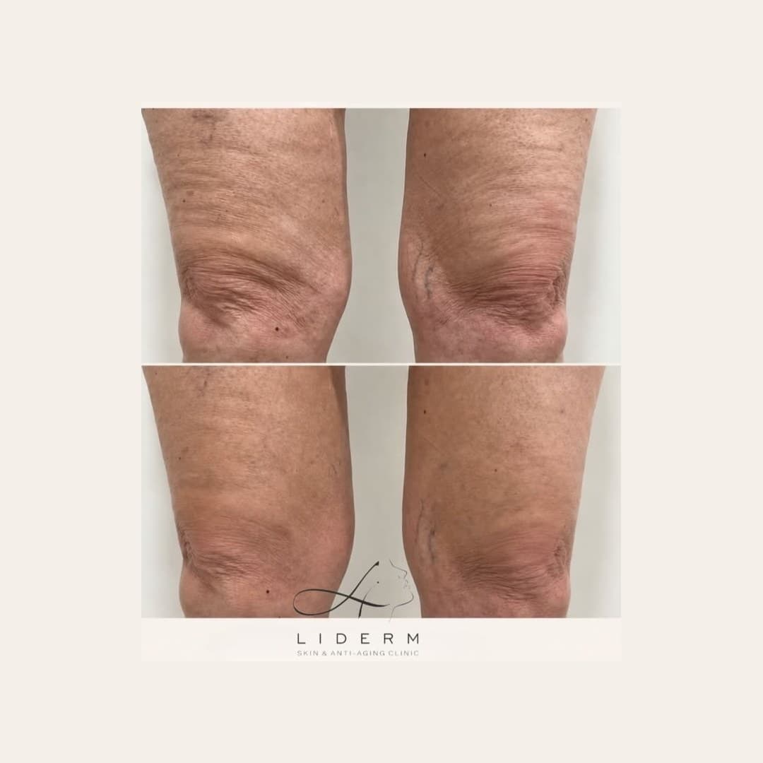 Результат — до и после в клинике LIDERM