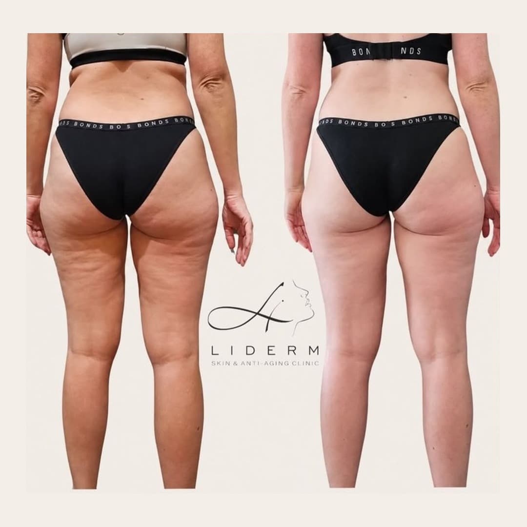 Результат — до и после в клинике LIDERM