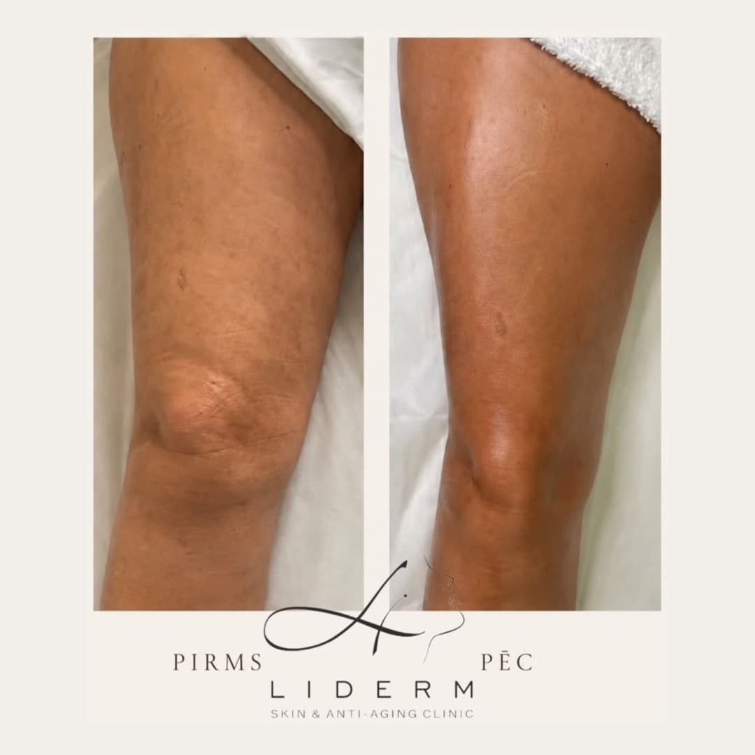 Результат — до и после в клинике LIDERM
