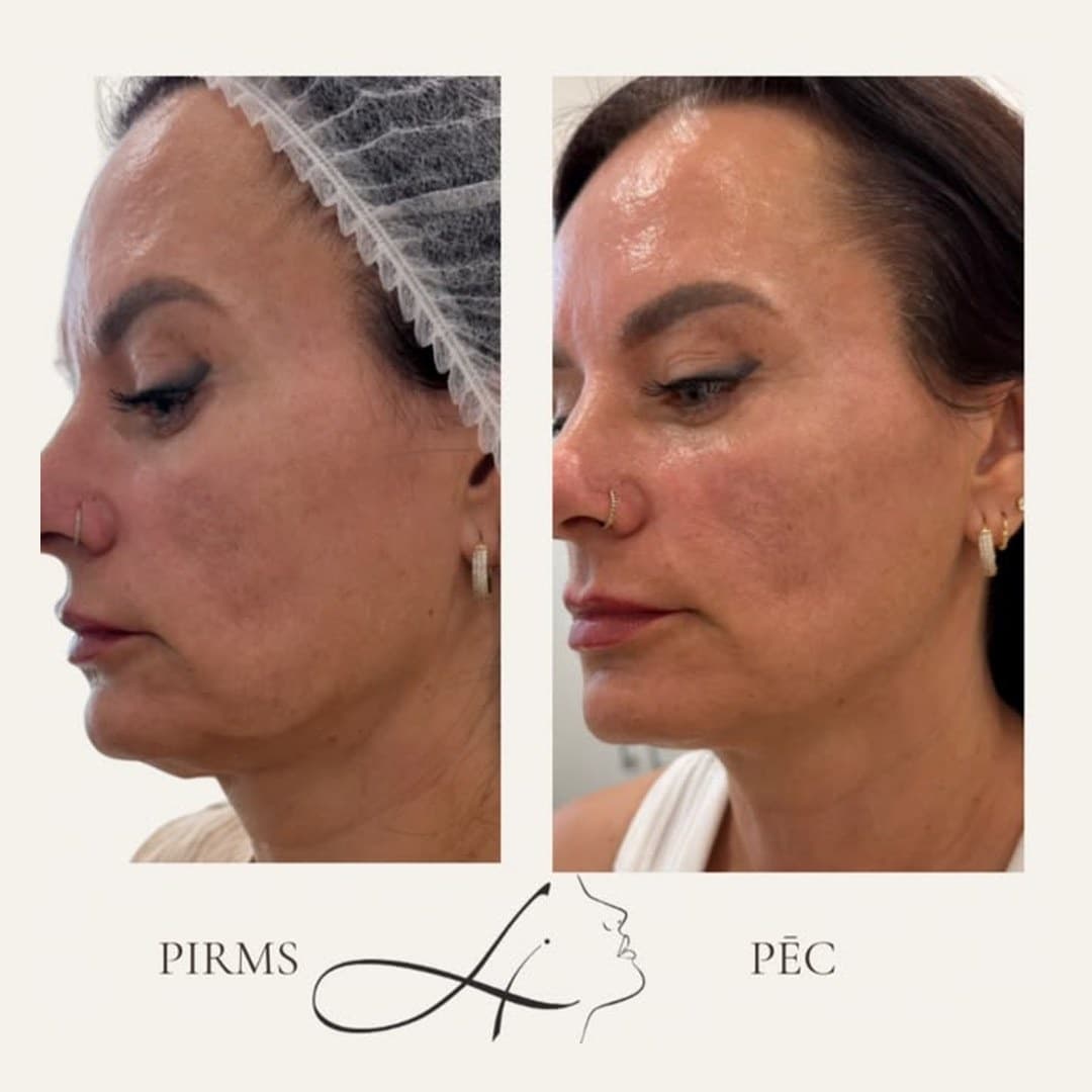 Rezultāts — pirms un pēc LIDERM klīnikā