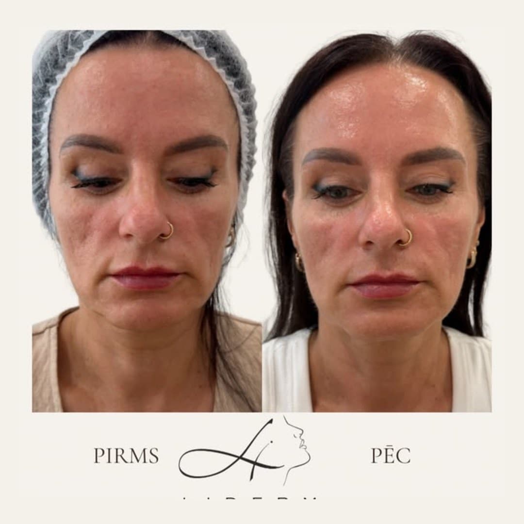 Rezultāts — pirms un pēc LIDERM klīnikā