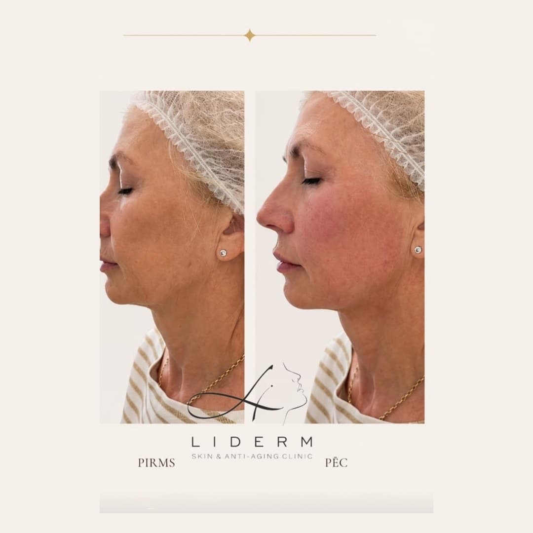 Rezultāts — pirms un pēc LIDERM klīnikā