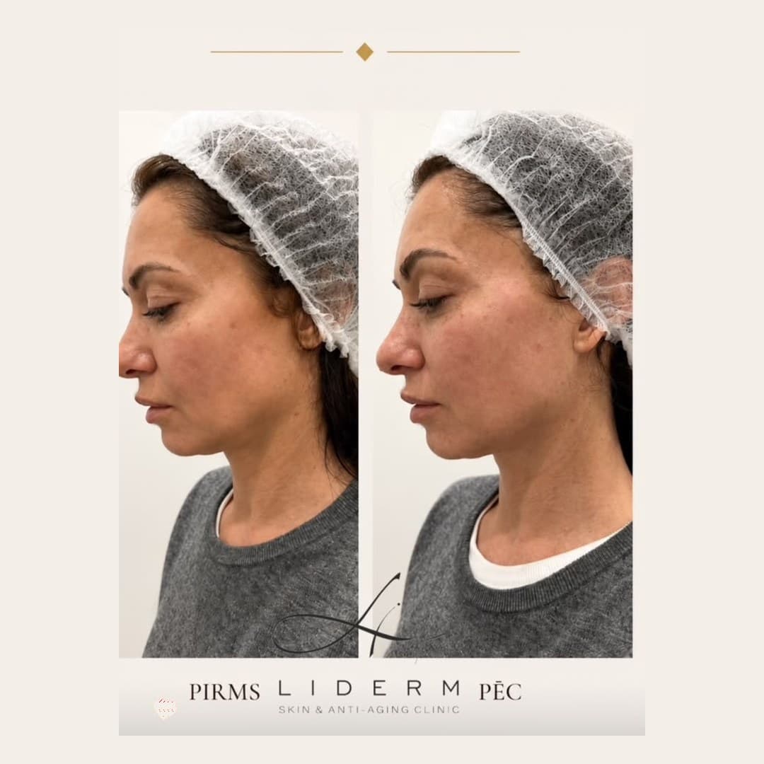 Rezultāts — pirms un pēc LIDERM klīnikā